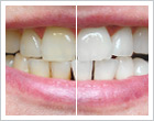 Tooth whitening at Vitaleurope Budapest