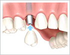 dental bridge at Budapest clinic